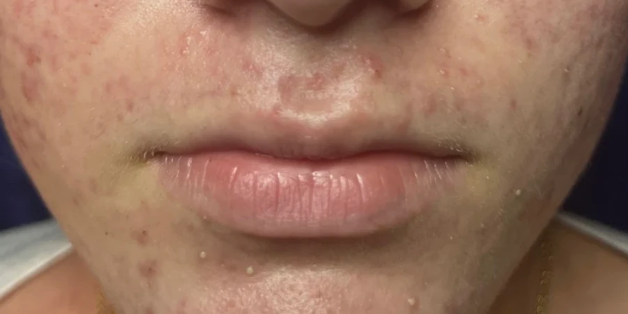 Acne Facial, before