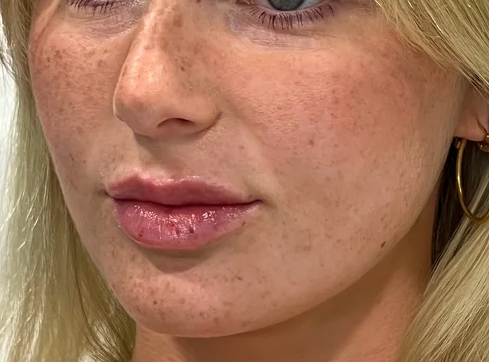 Lip Filler, after