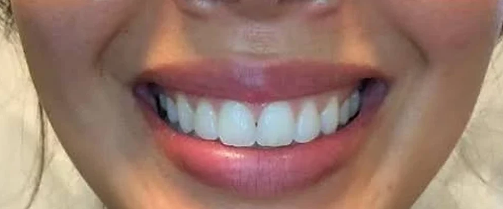 Lip Flip, after