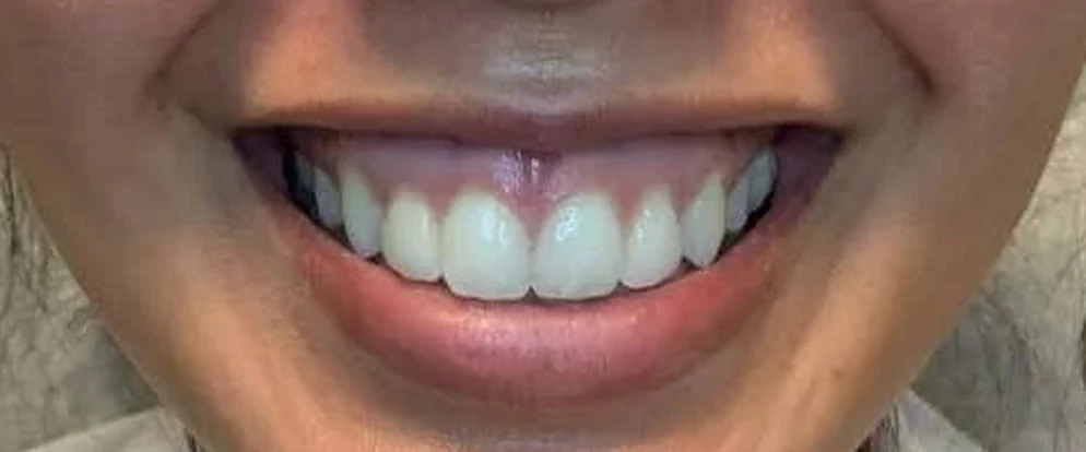 Lip Flip, before