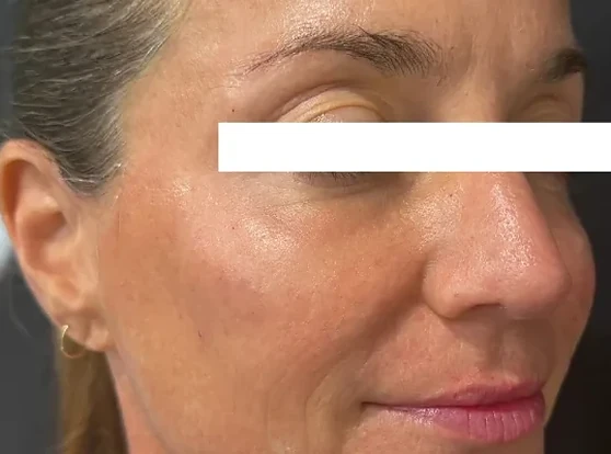 Xeomin, after