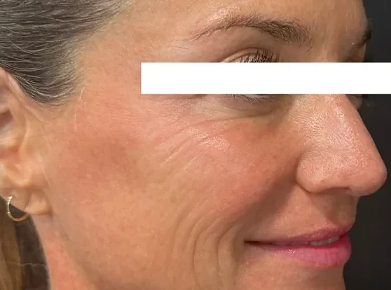 Xeomin, before